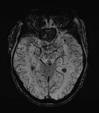 Cerebral amyloid angiopathy (Radiopaedia 46082-50433 Axial SWI MIP 32).png
