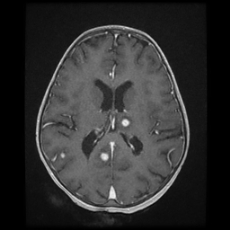 Cerebral and spinal tuberculosis (Radiopaedia 90489-107837 Axial T1 C+ 117).jpg