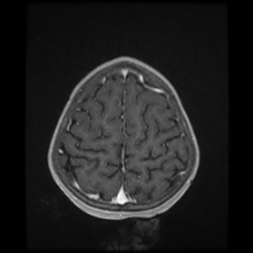 File:Cerebral and spinal tuberculosis (Radiopaedia 90489-107837 Axial T1 C+ 161).jpg