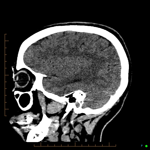 Cerebral arteriovenous malformation (AVM) (Radiopaedia 78162-90706 A 58).jpg