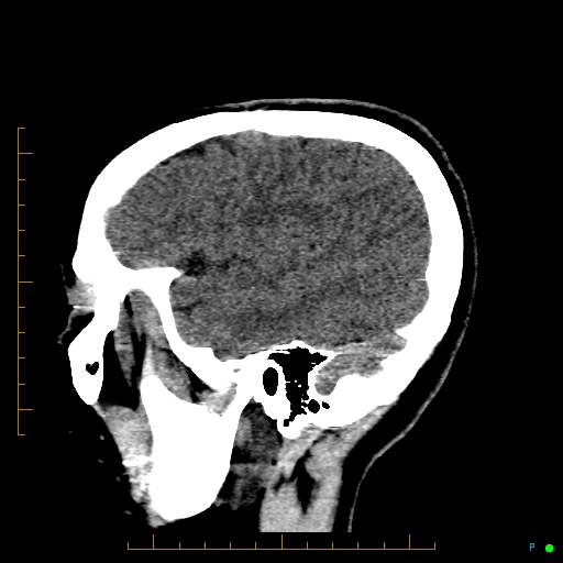 Cerebral arteriovenous malformation (AVM) (Radiopaedia 78162-90706 A 62).jpg