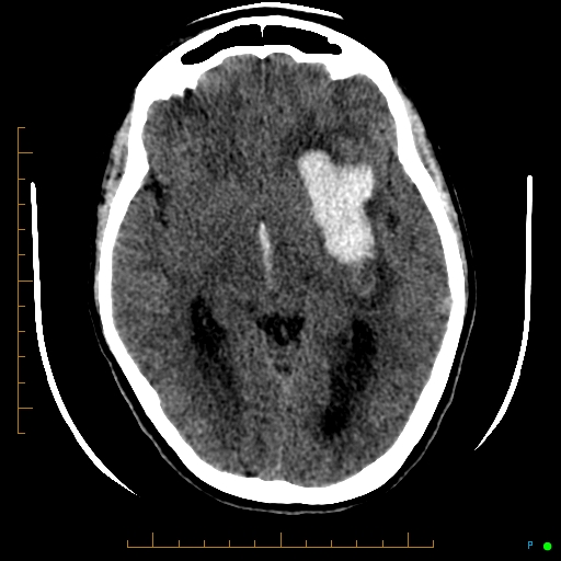Cerebral arteriovenous malformation (AVM) (Radiopaedia 78162-90706 Axial non-contrast 30).jpg