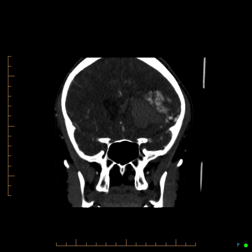 Cerebral arteriovenous malformation (AVM) (Radiopaedia 78162-90706 Coronal CTA 68).jpg