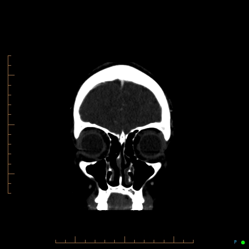 Cerebral arteriovenous malformation (AVM) (Radiopaedia 78162-90706 Coronal CTA 87).jpg