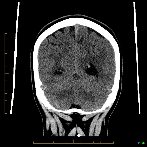 Cerebral arteriovenous malformation (AVM) (Radiopaedia 78162-90706 Coronal non-contrast 74).jpg