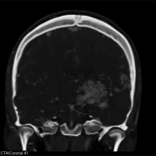 Cerebral arteriovenous malformation (Radiopaedia 28518-28759 C 41).jpg