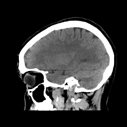 File:Cerebral arteriovenous malformation (Radiopaedia 39259-41505 B 25).png