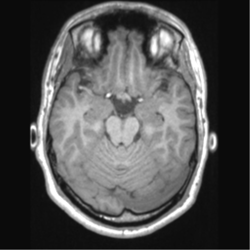 File:Cerebral arteriovenous malformation (Radiopaedia 39259-41506 Axial T1 29).png