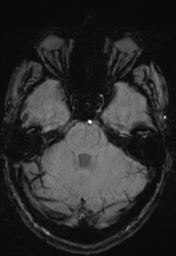 File:Cerebral arteriovenous malformation (Radiopaedia 55798-62372 Axial SWI 11).png