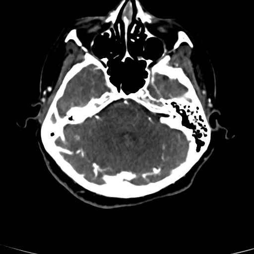 Cerebral arteriovenous malformation (Radiopaedia 73830-84645 Axial C+ delayed 69).jpg