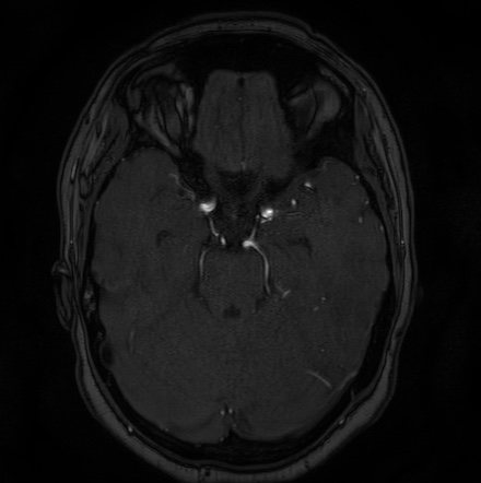 Cerebral arteriovenous malformation (Radiopaedia 74411-85654 Axial MRA 41).jpg