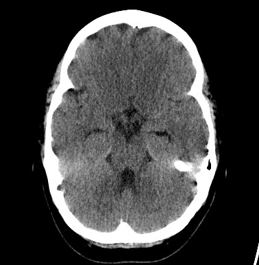 File:Cerebral arteriovenous malformation (Radiopaedia 74411-85744 Axial non-contrast 10).jpg