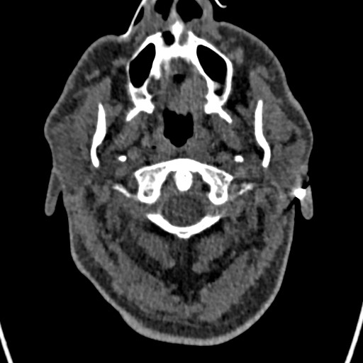 Cerebral arteriovenous malformation (Radiopaedia 78188-90746 Axial non-contrast 4).jpg