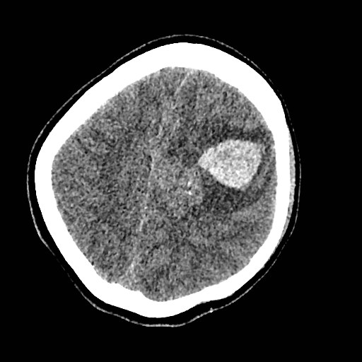 Cerebral arteriovenous malformation (Radiopaedia 79677-92887 Axial non-contrast 31).jpg