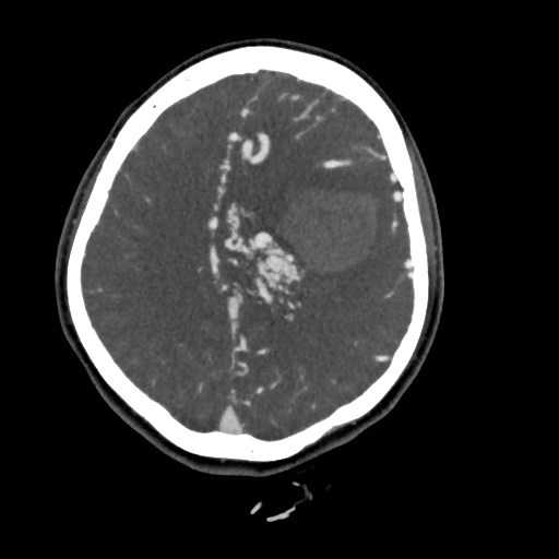 File:Cerebral arteriovenous malformation (Radiopaedia 79677-92888 A 39).jpg