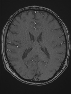 Cerebral arteriovenous malformation (Radiopaedia 84015-99245 Axial TOF 143).jpg