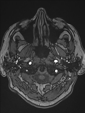 Cerebral arteriovenous malformation (Radiopaedia 84015-99245 Axial TOF 32).jpg