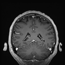 Cerebral arteriovenous malformation (Radiopaedia 84015-99245 Coronal T1 C+ 111).jpg