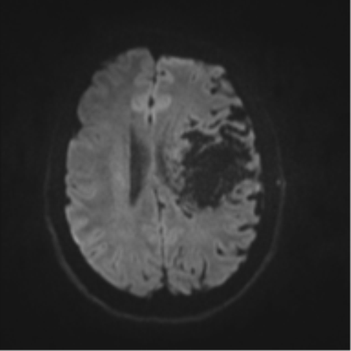 File:Cerebral arteriovenous malformation - huge (Radiopaedia 35734-37272 Axial DWI 38).png