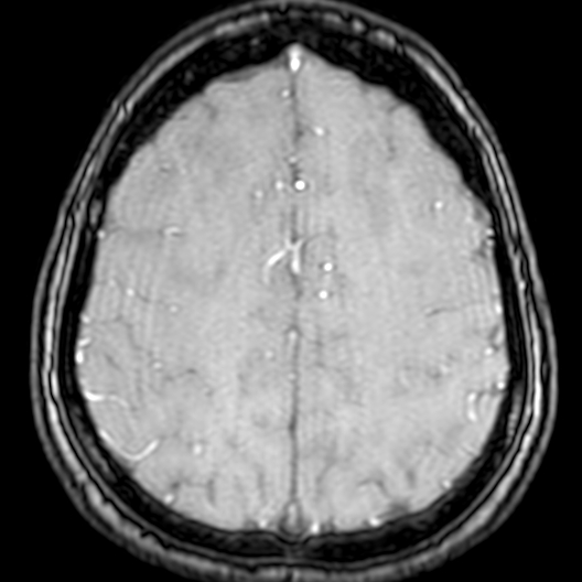 Cerebral arteriovenous malformation at posterior body of corpus callosum (Radiopaedia 74111-84925 Axial MRA 172).jpg