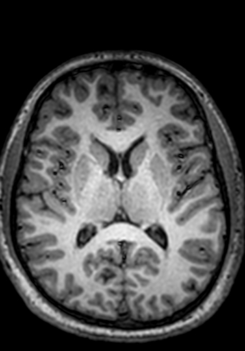 Cerebral arteriovenous malformation at posterior body of corpus callosum (Radiopaedia 74111-84925 Axial T1 133).jpg