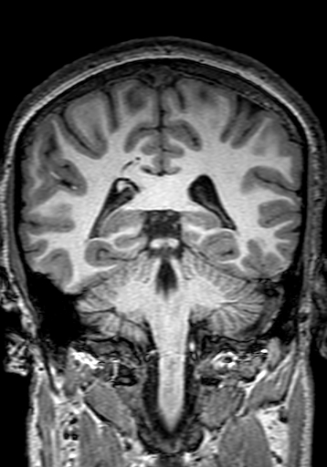Cerebral arteriovenous malformation at posterior body of corpus callosum (Radiopaedia 74111-84925 Coronal T1 220).jpg