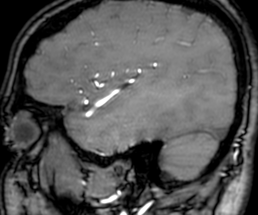Cerebral arteriovenous malformation at posterior body of corpus callosum (Radiopaedia 74111-84925 J 322).jpg