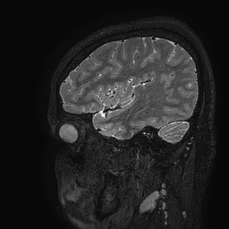 Cerebral arteriovenous malformation at posterior body of corpus callosum (Radiopaedia 74111-84925 Sagittal T2 109).jpg