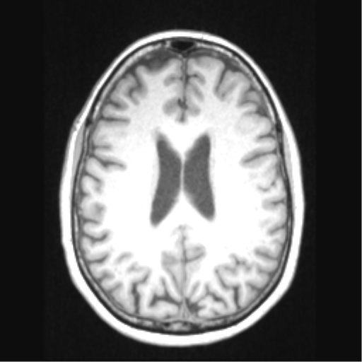 Cerebral arteriovenous malformation with hemorrhage (Radiopaedia 34422-35737 Axial T1 49).png
