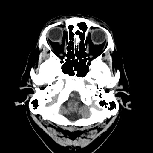 Cerebral arteriovenous malformation with lobar hemorrhage (Radiopaedia 35598-37117 Axial non-contrast 5).jpg