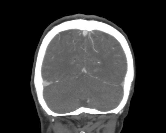 Cerebral arteriovenous malformation with lobar hemorrhage (Radiopaedia 44725-48511 A 48).png