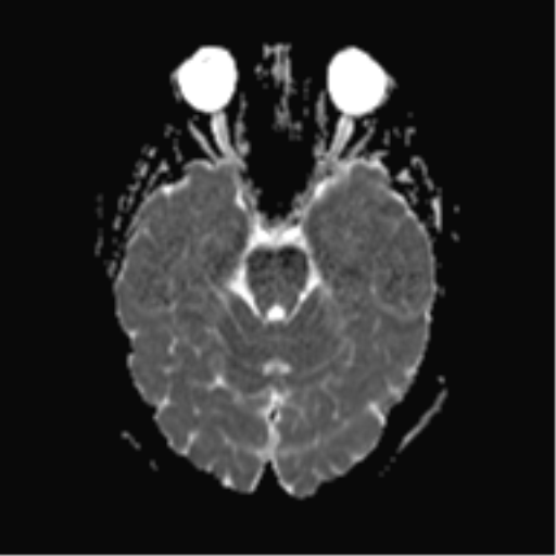 File:Cerebral cavernoma and development venous anomaly (Radiopaedia 37603-39482 Axial ADC 8).png