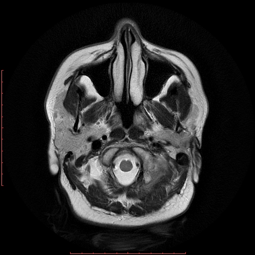 File:Cerebral cavernous malformation (Radiopaedia 26177-26306 Axial T2 3).jpg