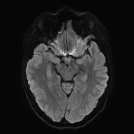 File:Cerebral cavernous venous malformation (Radiopaedia 70008-80021 Axial DWI 43).jpg