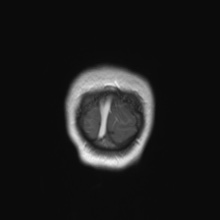 Cerebral cavernous venous malformation (Radiopaedia 70008-80021 Coronal T1 C+ 3).jpg