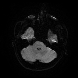 File:Cerebral cavernous venous malformation (Zabramski type II) (Radiopaedia 85511-101198 Axial DWI 10).jpg