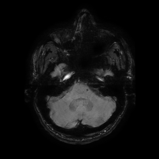Cerebral cavernous venous malformation (Zabramski type II) (Radiopaedia 85511-101198 Axial SWI 33).jpg
