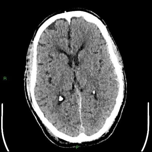 Cerebral contusions (Radiopaedia 33868-35039 Axial non-contrast 107).jpg