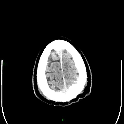 Cerebral contusions (Radiopaedia 33868-35039 Axial non-contrast 202).jpg