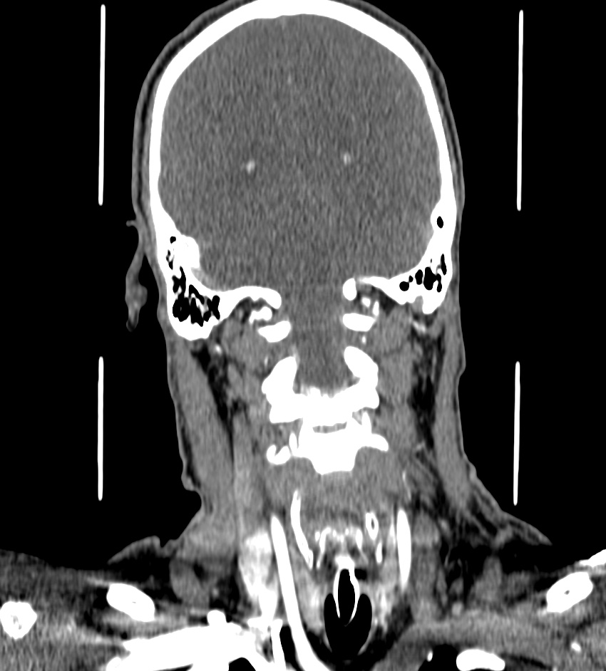 Cerebral edema in an overdose patient (Radiopaedia 72005-82539 B 105).jpg