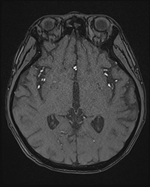 Cerebral embolic infarcts (embolic shower) (Radiopaedia 72391-82921 Axial MRA 83).jpg