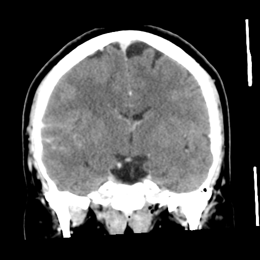 Cerebral hemorrhage secondary to arteriovenous malformation (Radiopaedia 33497-34561 C 32).png