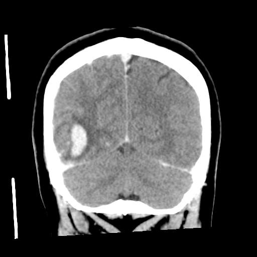 Cerebral hemorrhage secondary to arteriovenous malformation (Radiopaedia 33497-34561 C 52).png