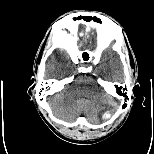 File:Cerebral hemorrhagic contusions- temporal evolution (Radiopaedia 40224-42754 Axial non-contrast 6).png