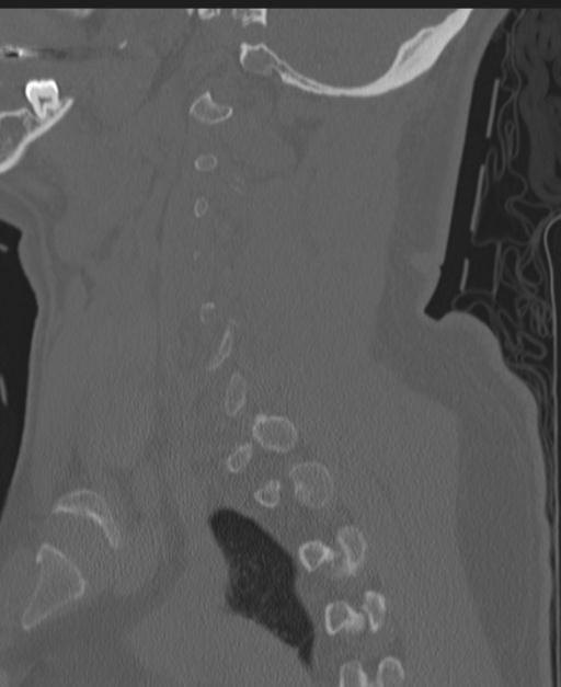 Cerebral hemorrhagic contusions and cervical spine fractures (Radiopaedia 32865-33841 Sagittal bone window 32).jpg