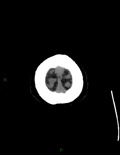 Cerebral metastases - ependymal and parenchymal (Radiopaedia 79877-93131 Axial non-contrast 79).jpg