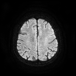 Cerebral metastases - melanoma (Radiopaedia 80972-94522 Axial DWI 53).jpg