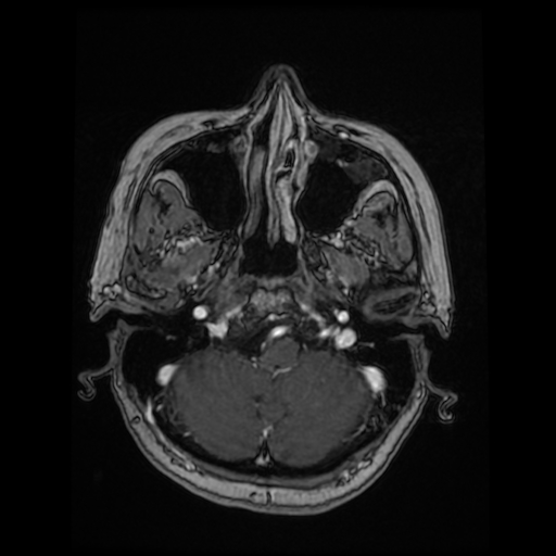 File:Cerebral metastases - melanoma (Radiopaedia 80972-94522 Axial T1 C+ 31).jpg