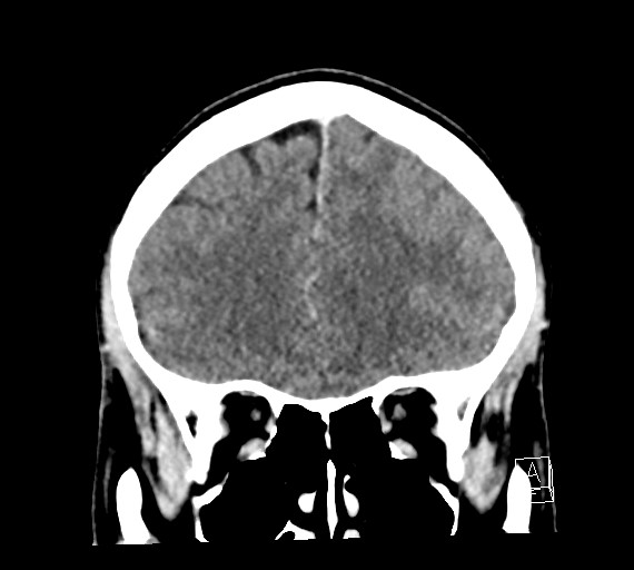 Cerebral metastases - testicular choriocarcinoma (Radiopaedia 84486-99855 D 18).jpg