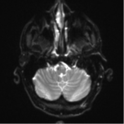 Cerebral metastasis - melanoma (Radiopaedia 54718-60954 Axial DWI 6).png
